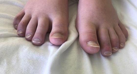 Koronavírus-fertőzés miatt olyan hólyagok és kiütések lettek egy skót lány lábán, hogy alig tud járni