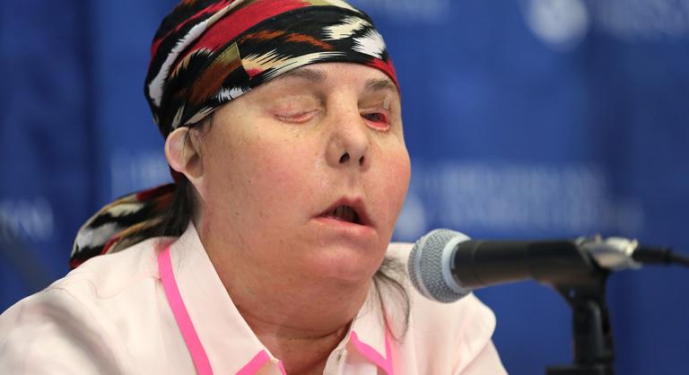 Második arcátültetésén esett át egy nő az Egyesült Államokban