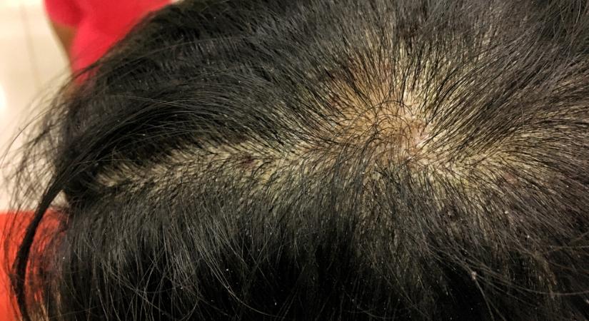 A viszkető fejbőr okai és kezelése
