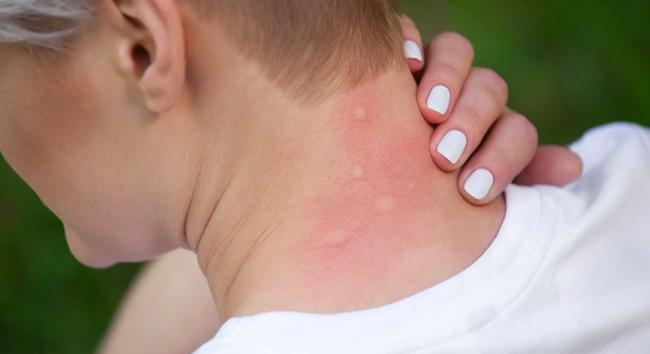 Kegyetlen agresszor a mocsári szúnyog: iszonyatosan fáj a csípése!