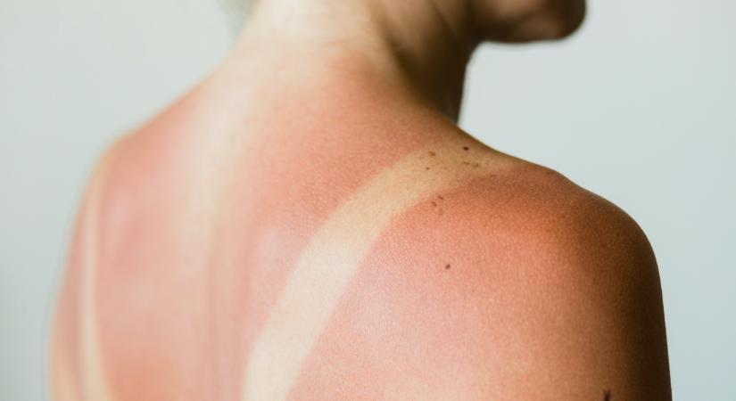 Bevált tippek napégésre: csökkentik a kipirosodást és az égő bőrérzetet