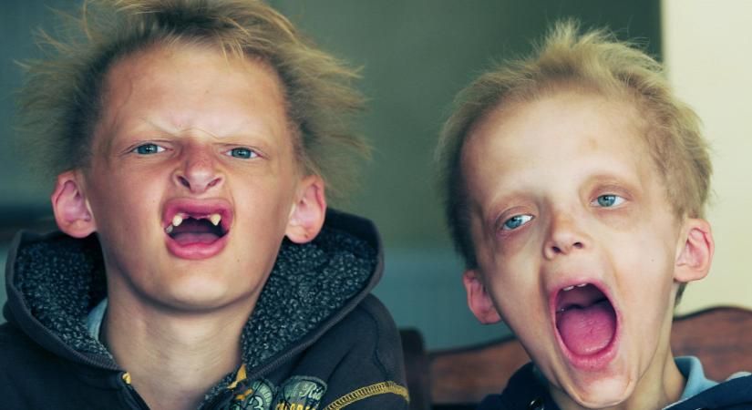 Fényérzékeny bőr, vérvörös fogak: a porfíria betegség a vámpírlegendák alapja