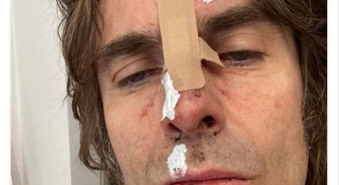 Liam Gallagher összetörte az arcát