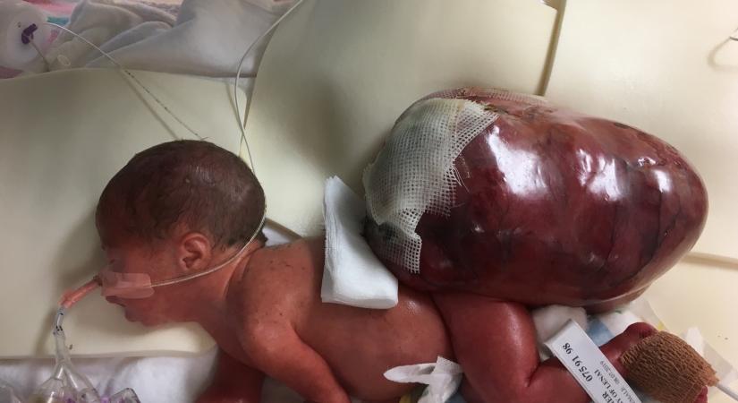 Saját testénél másfélszer nehezebb daganattal született egy kisbaba - Fotó (18+)