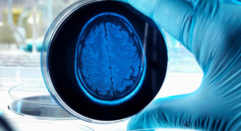 Szegedi kutatók olyan gyógyszerhatóanyagokat azonosítottak, amelyek sikerre vihetik az Alzheimer- és a Parkinson-kór terápiáját