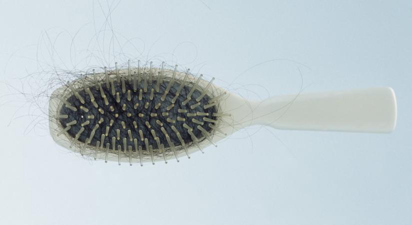 Tömegeket érinthet a koronavírussal összefüggésbe hozott hajhullás, de jó tudni, hogy nem új betegségről van szó