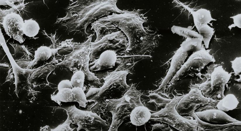 Fényérzékeny, nanoméretű bioanyaggal támadhatóak meg a rosszindulatú daganatok