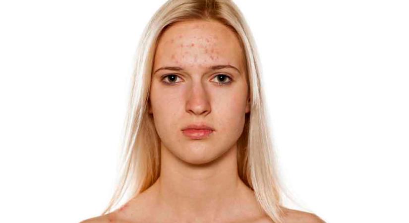 Pattanásos arcbőr – Nem csak a higiénia hiánya okozhatja