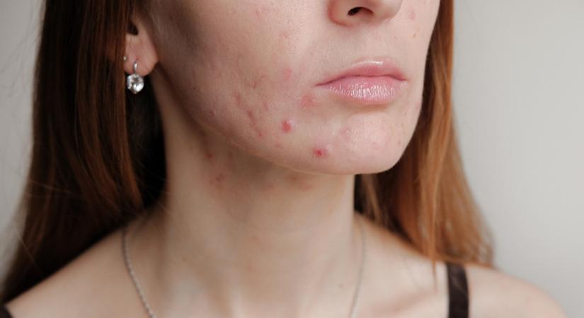 Minden, amit a pattanásos bőr kezeléséről tudni kell: csökken a gyulladás, ha ezekre odafigyelsz