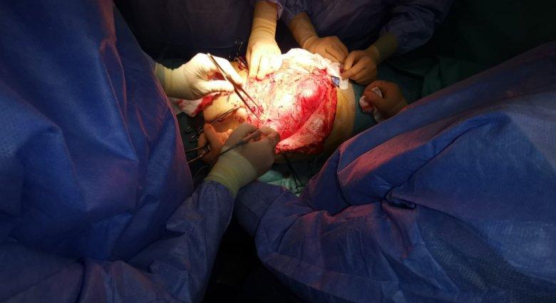 Hatalmas tumort távolítottak el egy páciens hasüregéből Marosvásárhelyen