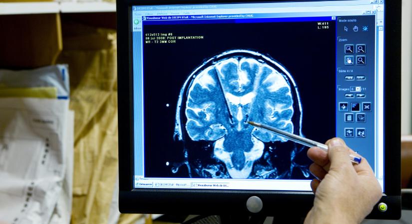Kiderült, melyik betegség gyorsítja drasztikusan az agy normál öregedését