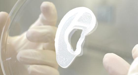 3D-nyomtatással készült fület kapott egy 20 éves nő, ez volt a világ első ilyen műtétje