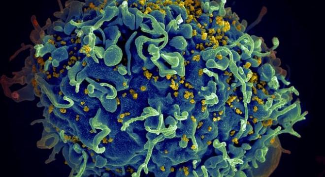 Génszerkesztéssel gyógyíthatják a HIV-fertőzést