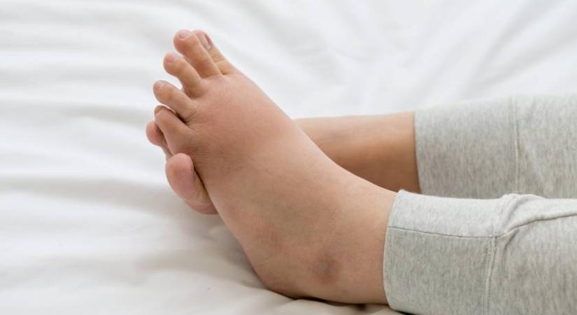 Érkárosodást és vesebetegséget is jelezhet a lábak dagadása: 5 tünet, amikor muszáj orvoshoz fordulni vele