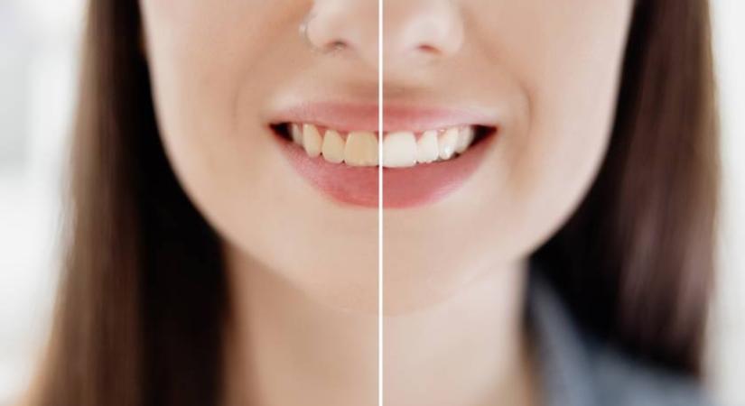 Szódabikarbóna és citromlé: tönkreteszed velük a fogaidat, vagy tényleg fehérítheted őket?