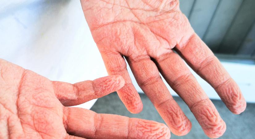 Miért áznak ráncossá az ujjaink? Betegséget is jelezhetnek