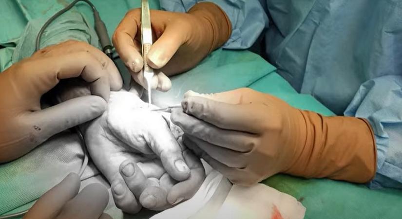 Elképesztő: leszakadt kézfejet varrtak vissza a pécsi traumatológiai klinikán!