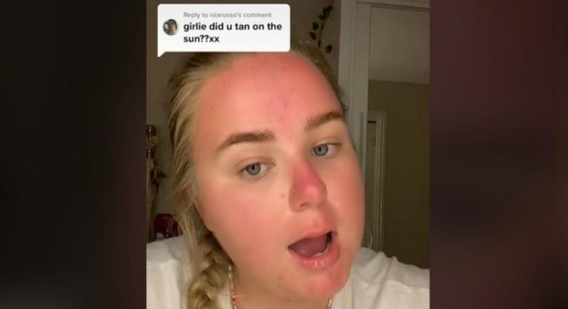 Angliai hőhullám: hólyagosra égett a lány arca a napon