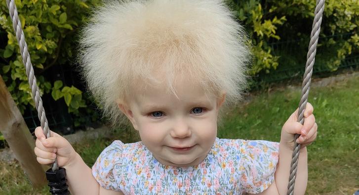 Egy nagyon ritka szindróma miatt egyszerűen lehetetlen megfésülni ennek a kislánynak a haját