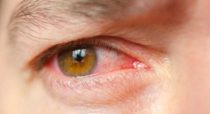 Nem csak az allergiától lehet vörös a szem