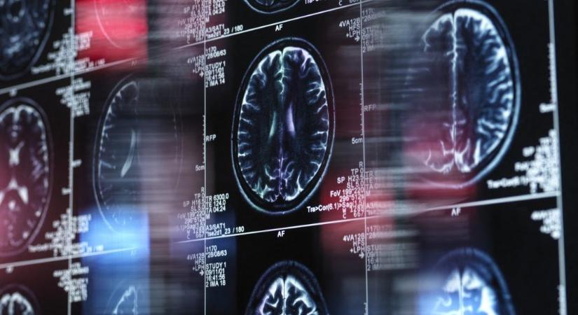 Hamisított adatokra épülhet az Alzheimer-kór kutatása