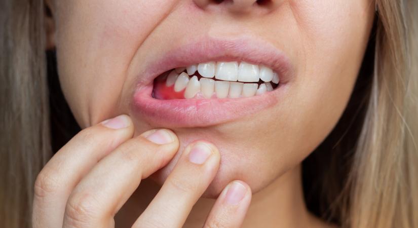 Vérző fogíny: ilyen, amikor rosszindulatú tumort jelez