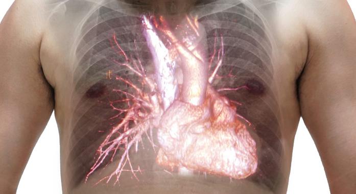 Pulmonális szívbetegség (cor pulmonale)
