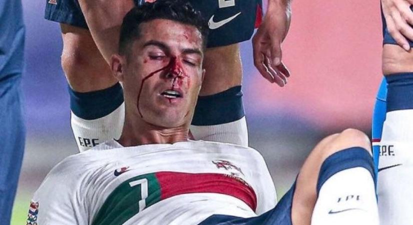 NL: Vérben úszott Cristiano Ronaldo arca, akkorát kapott a kapustól - videó, fotók