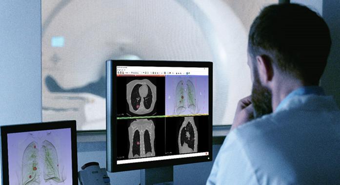 Tüdőrák diagnosztika: mesterséges intelligencia segít mellkas CT felvétel alapján