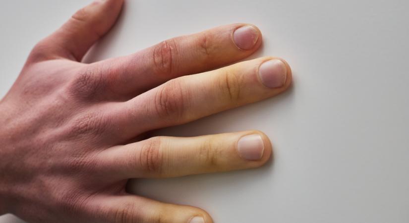Így jelezheti az ujj az autoimmun betegséget