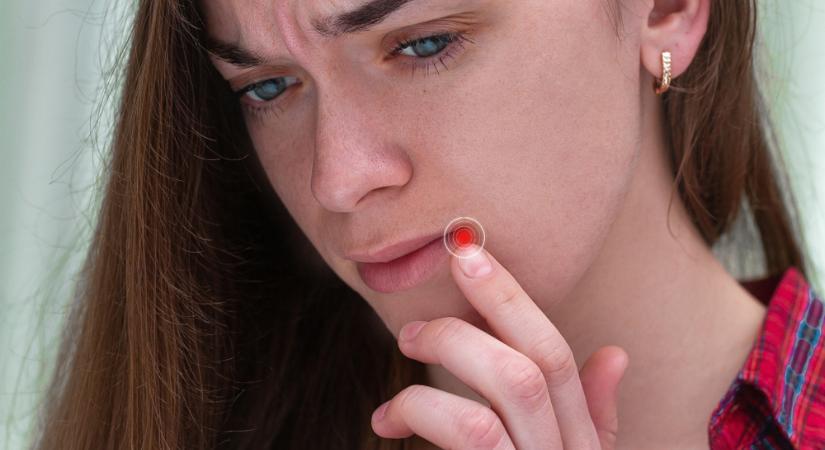 Akkor is kijöhet a herpesz a szájon, ha nem esett jól az étel? Vakcinainfó - Az orvos válaszol