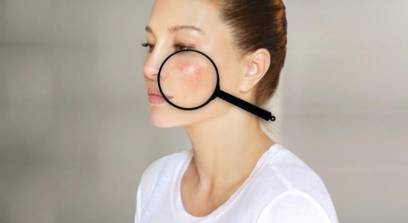 Vigyázzon, ha a bőrpír így jelenik meg az arcán - autoimmun betegség jele is lehet
