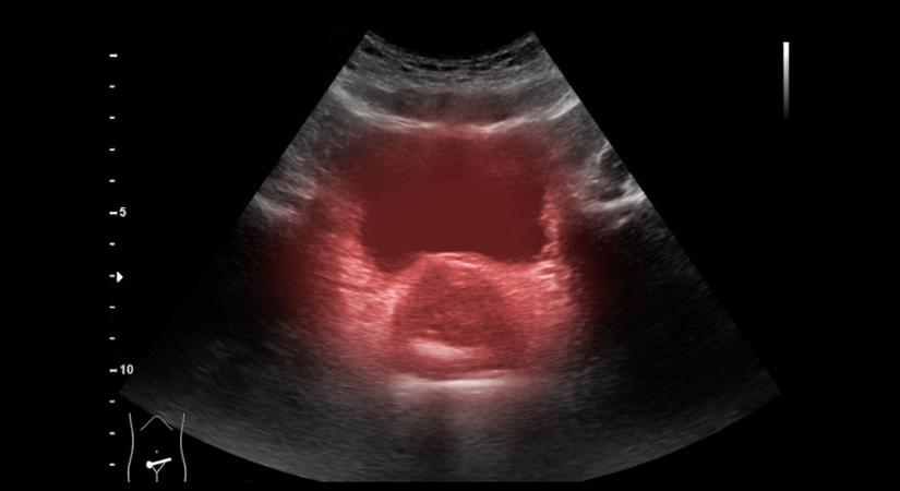 Vizelési nehézségek, véres vizelet: ez az ultrahang szerepe a kivizsgálásában