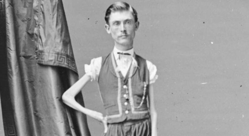 Élő csontvázként mutogatták cirkuszokban a 19 kilós férfit