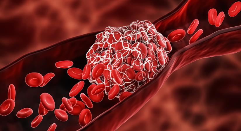 Trombózis, tüdőembólia covid után: meddig alakulhatnak ki nagyobb eséllyel vérrögök?