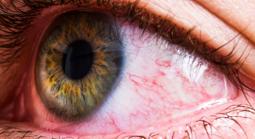 Vörös szem: ezek a betegségek okozhatják