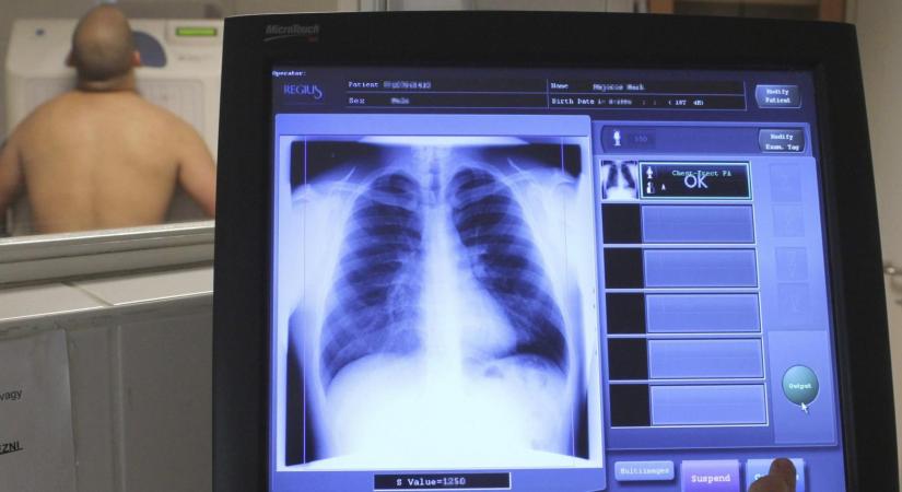Orvosi vizsgálat: mikor kötelező a tüdőszűrés a munkavállalónak?