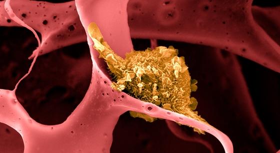 A sószemnél 2500-szor kisebb nanobuborékokkal robbantanák fel a daganatsejteket a kutatók