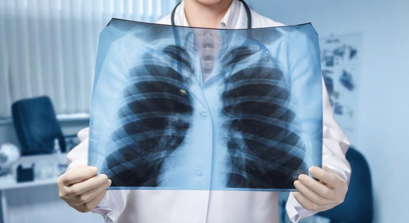 Okozhat rákot a röntgen? Vakcinainfó - Az orvos válaszol