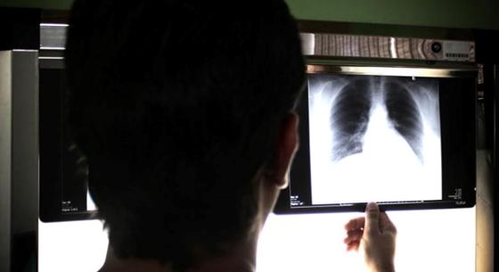 Egyetlen röntgenfelvételből megmondja a mesterséges intelligencia, 10 éven belül lesz-e szívrohamunk