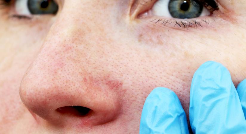 Pókhálóerek az orron és az arcon - ez a bőrgyógyász tanácsa rosacea esetén
