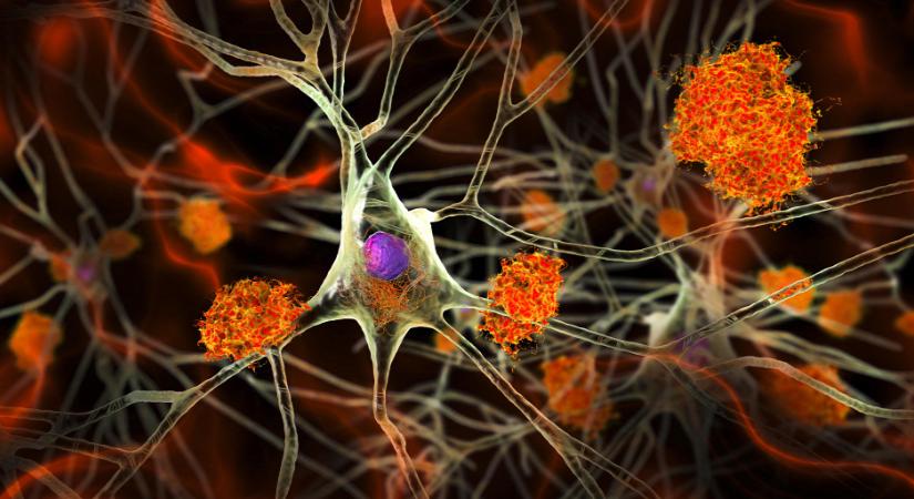 Az Alzheimer-kór kezelésének új korszaka jöhet