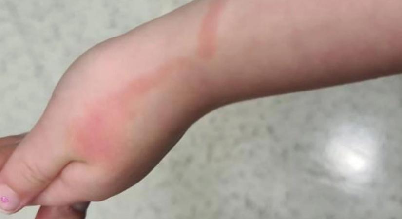 Vérmérgezés: ha a sebből ilyen piros csík indul el a szív felé, hívjon orvost!