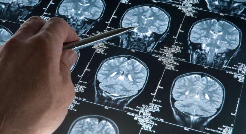 Csak 19 éves a világ legfiatalabb Alzheimer-kóros betege