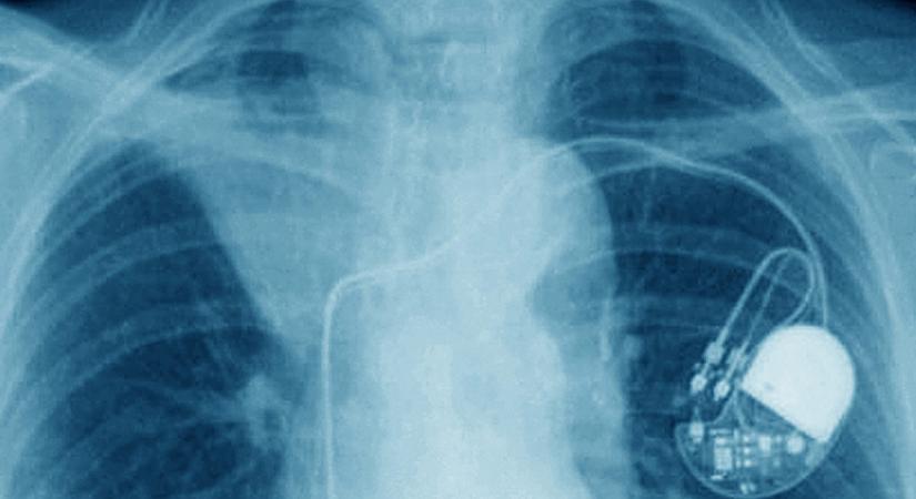 Betegek százaiba ültethette be halottak pacemakereit egy orvos