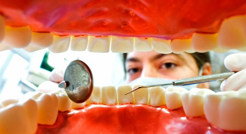 Veszélyes kapcsolat a fogak állapota és az agyvérzés között