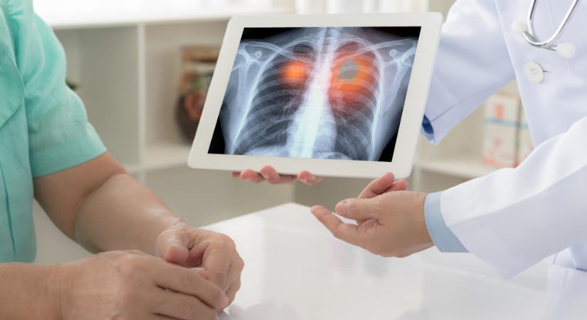 Tüdőrák - ezért kevés magában tüdőszűrés