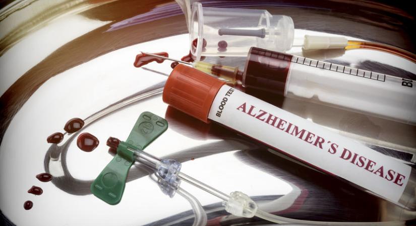 A trombociták depléciója súlyosbítja az Alzheimer-kór klinikai tüneteit