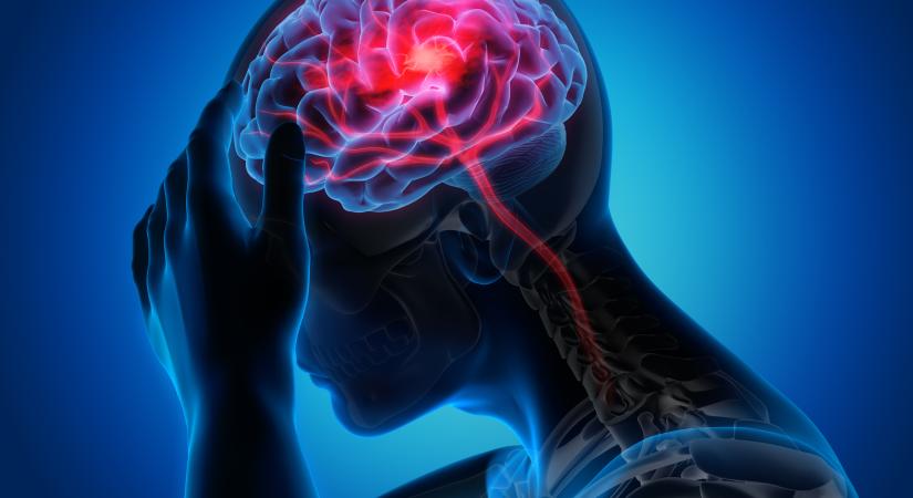 Stroke: náluk alakulhat ki nagyobb eséllyel a kutatók szerint