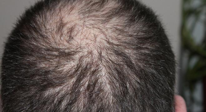 Mit érdemes tudni a foltos hajhullásról?